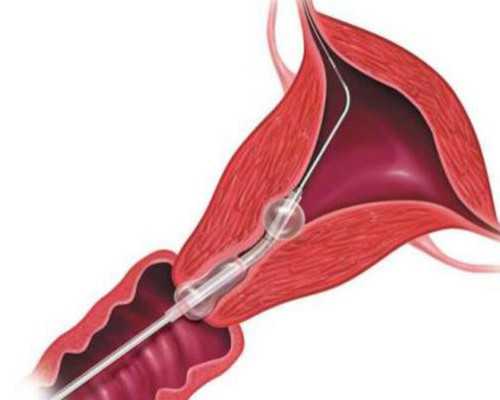 中西医结合调理试管周期黄体功能