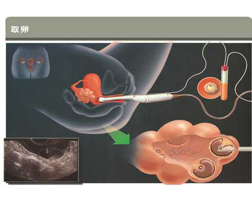 广州代生得子,广州试管成功率高代妈,广州代妈公司哪家好